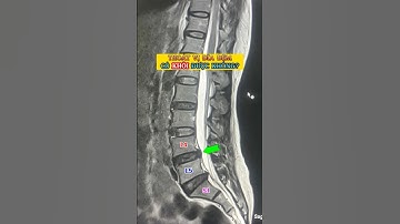 Thoát vị đĩa đệm có khỏi được không? Cùng xem video để biết câu trả lời nhé