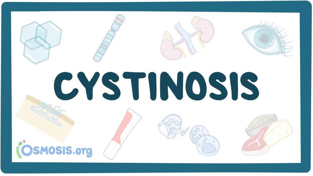 How Common Are Cystine Stones?