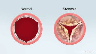 Transcatheter Aortic Valve Replacement (TAVR) Treatment for Aortic Stenosis