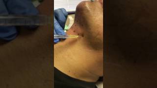 Kybella For Chin By San Diego, California Cosmetic Surgeon Dr. Reza Tirgari & Staff