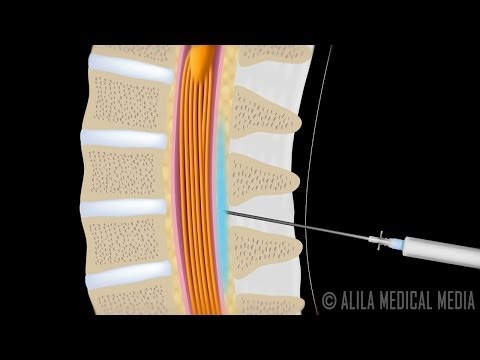 Lumbar Epidural Steroid Injection Animation.