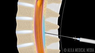 Lumbar Epidural Steroid Injection Animation.