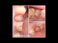 Case Demo Management Of Tooth With Pus Dr Mostafa Taha Case Demo Management Of Tooth With Pus Dr Mostafa Taha