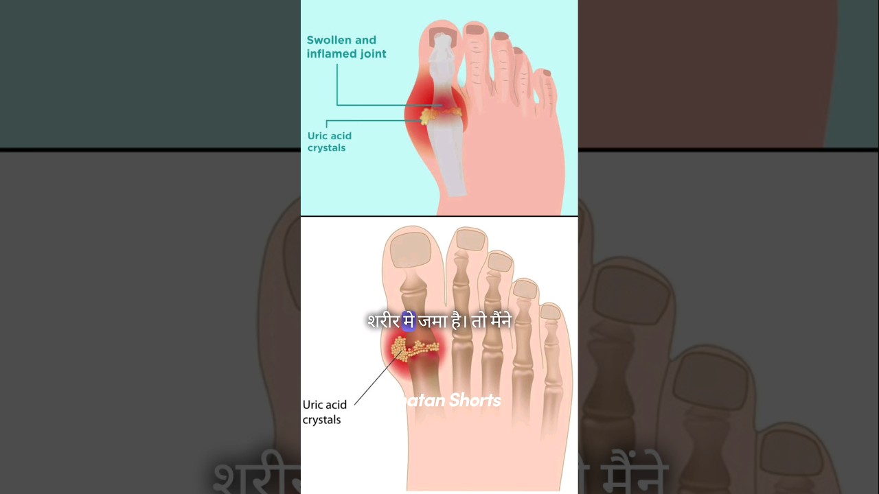 शरीर में uric acid जमा है तो क्या करें 🧐  #shorts #sanatandharm #health
