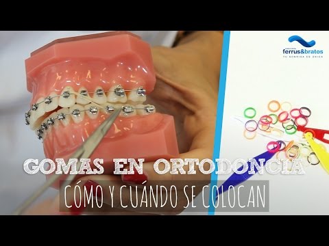 Video: Cómo conectar una banda elástica a sus aparatos ortopédicos: 12 pasos