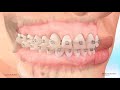 Shorter Animation Motion 3D and Aligners