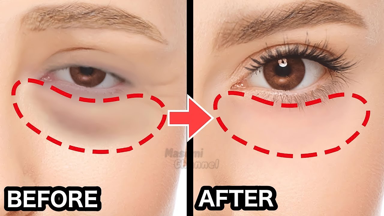 Common Types Of Eye Bags And How To Remove Them  DAPS