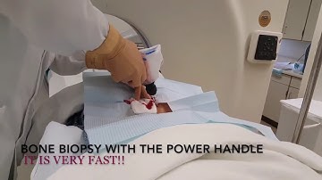 ALMOST PAINLESS BONE MARROW BIOPSY WITH ONCONTROL® POWERED BONE ACCESS SYSTEM