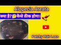 Alopecia Areata (Patchy Hair Loss)Hair Problem
