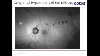OAO CE@Home  - The Importance of Autofluorescence in Retinal Pathology Diagnosis (Nov. 24, 2015)