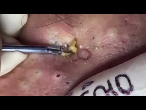 How to remove stubborn blackheads at home