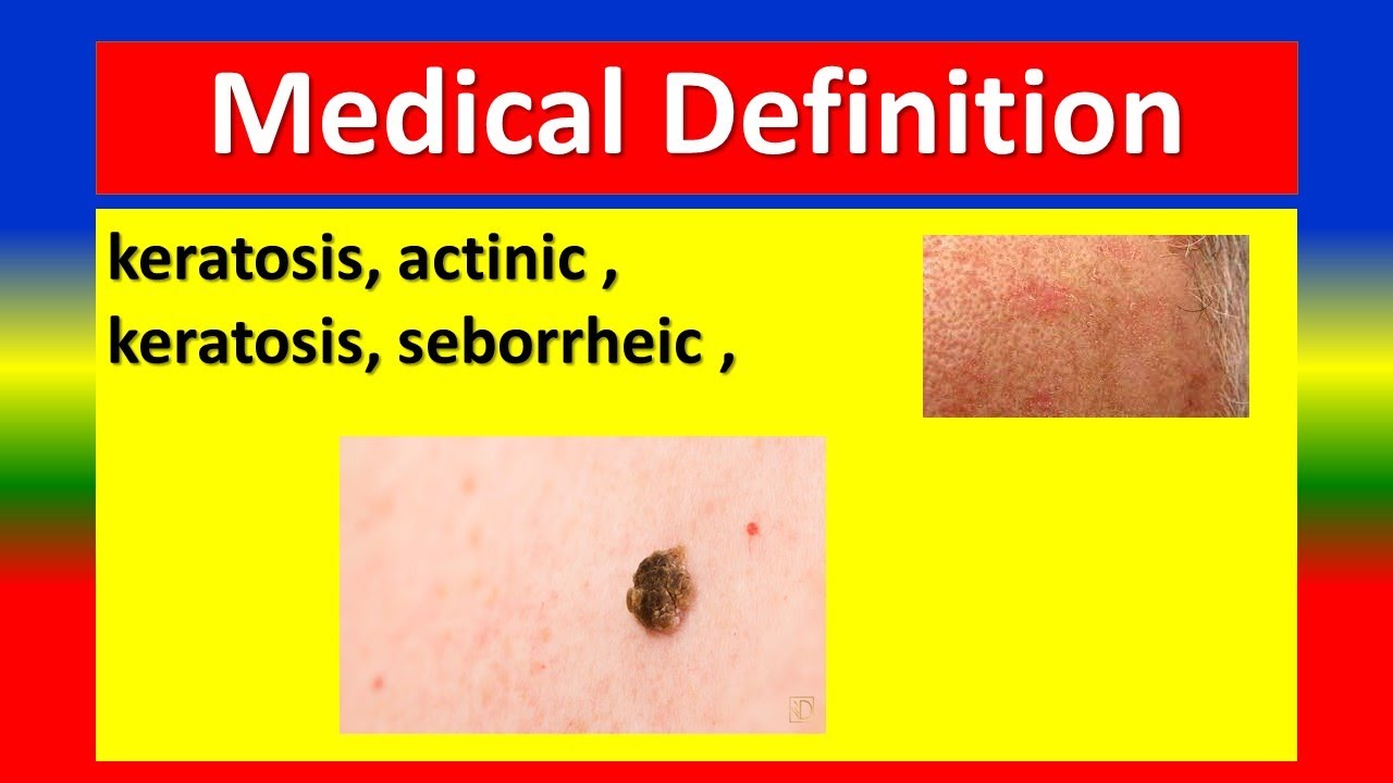 Medical Definition Keratosis Actinic Keratosis Seborrheic Youtube