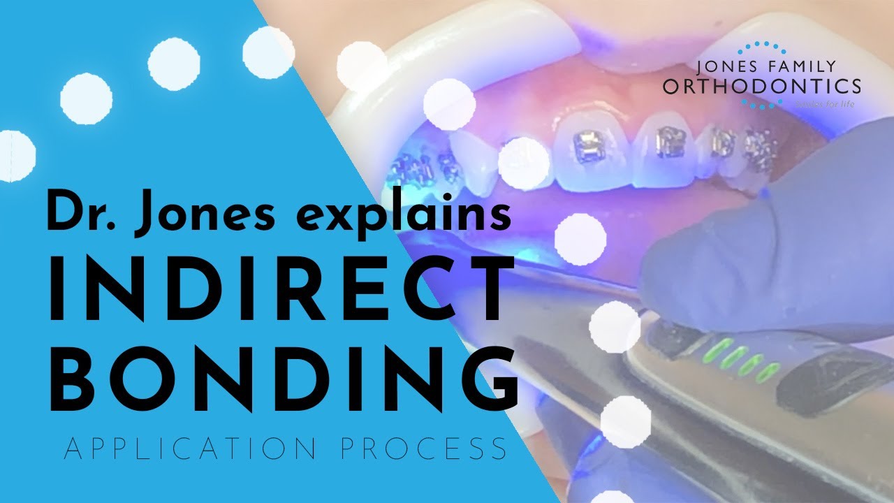 Dr. Jones Explains Indirect Bonding Application Process Jones