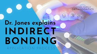 Dr. Jones Explains Indirect Bonding – Application Process | Jones Family Orthodontics | Monroe, WA