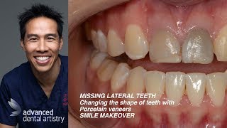 Changing Canines into Laterals - Congenitally Missing Front Teeth
