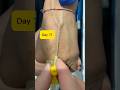24G IV Cannulation Technique on Prominent Hand Veins | Day 71 Practical Guide#safai#safi