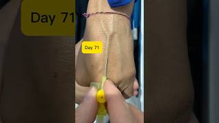 24G IV Cannulation Technique on Prominent Hand Veins | Day 71 Practical Guide#safai#safi