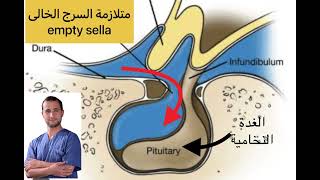متلازمة السرج الخالى empty sella syndrome