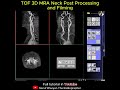 TOF 3D MRA Neck Post Processing and Filming | #mri #ctscan #xray #radiology #medicalimaging #radtech