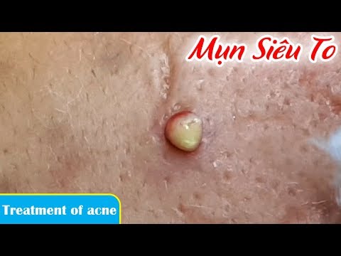 Điều trị mụn viêm- mụn bọc hiệu quả nhất |Treatment of acne|. Tại Hiền Vân Spa - bài 196