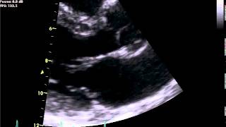 TTE Normal PLAX AV and MV zoom  Example 1