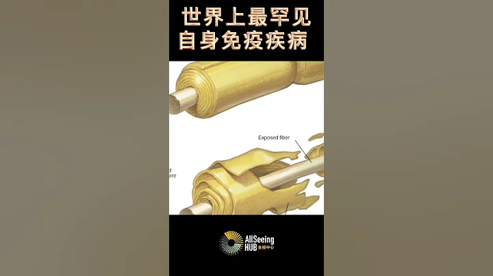 世界上最罕见的自身免疫疾病 格林-巴利综合症（GBS） / 任何人都可以患上这种疾病，但50岁以上人群风险更高 每10万人中就有1人 周围神经系统  / 症状—虚弱、脚或手刺痛、全身瘫痪 - 天天要闻