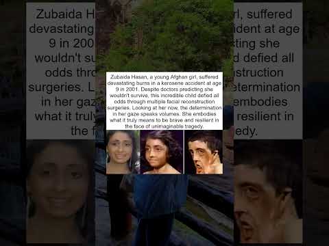 Burned At 9 Her Courage Never Faded 