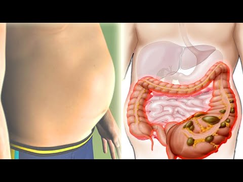 Wideo: Twardy żołądek: Przyczyny I Czas Wizyty U Lekarza