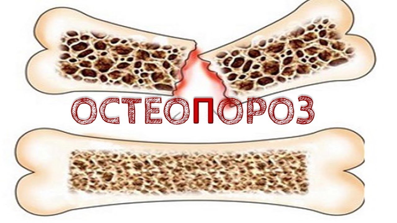 Остеопороз хрупкость костей Рекомендации по питанию #1 - YouTube
