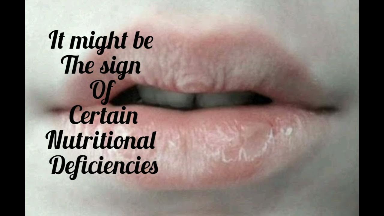 Are chapped lips due to vitamin deficiency!!? YouTube