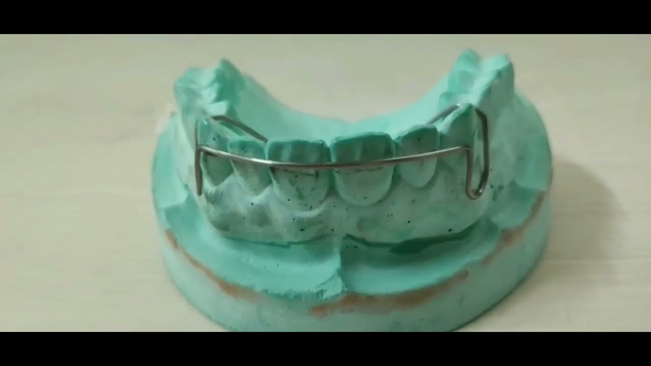 Labial Bow Orthodontics YouTube