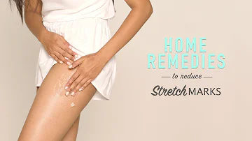 Can I remove stretch marks permanently?