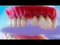 Como prevenir la periodontitis y qué hacer si ya la tengo