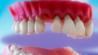 Como prevenir la periodontitis y qué hacer si ya la tengo