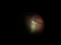 HyperVit Fragmentation - Retained Nucleus Removal