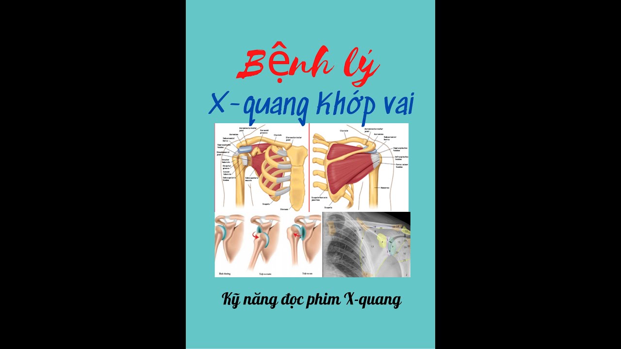 Bệnh Lý X-quang Khớp Vai