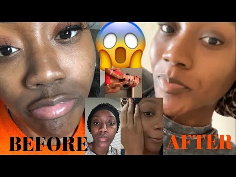 COMMENT DÉBARASSER hyperpigmentation & MELASMA FAST | MÊME ROUTINE TEINT | I BLANCHI MA PEAU ?!