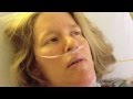 Open heart surgery video dairy, hypertrophic cardiomyopathy