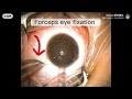 ICL surgery: step 2. Corneal incision and lens placement