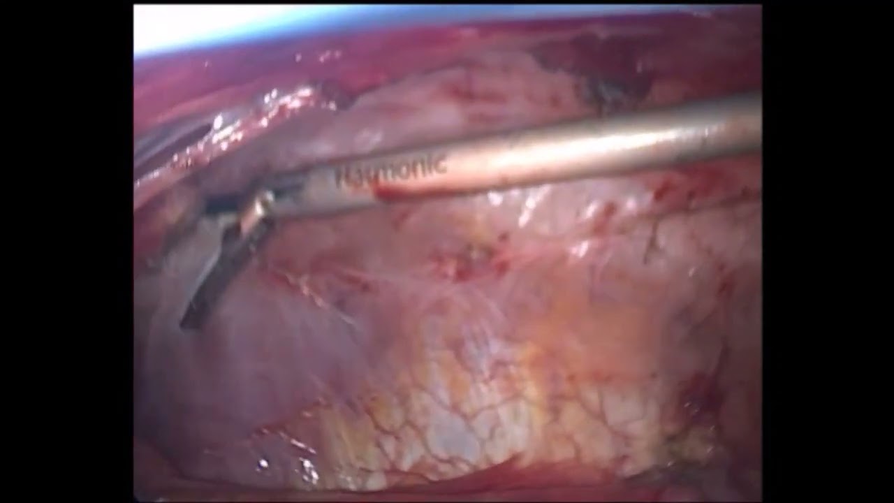 VATS Right Lower Lobectomy for intraplumonary Sequestration- Fissureless Technique