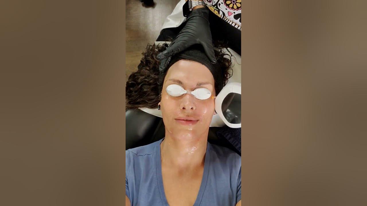 laser-dark-spot-removal-youtube