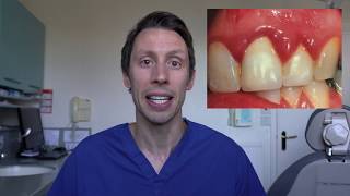 A patient's guide to gum disease & interdental cleaning