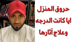 حروق المنزل ايا كانت الدرجه وعلاج آثارها - دكتور طلال