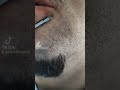 pustule care se extrag cu atenție și ustensile sterile sau de unică folosință!..