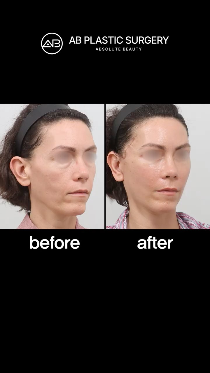 The Power of Lower Blepharoplasty 🤍 #Shorts