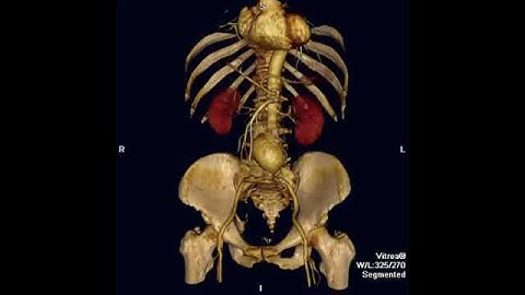 Vascular Biomechanics Computational Modeling.m4v