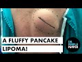 A Fluffy Pancake Lipoma