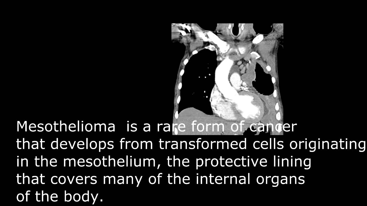 Crisp Mesothelioma Youtube Artwork for Your Screen Crisp Mesothelioma Youtube Artwork for Your Screen