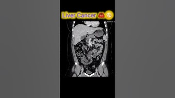 Liver Cancer CT scan