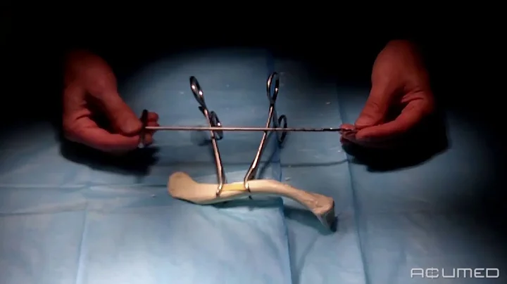 Acumed- Dual Trak Sawbones Technique Review